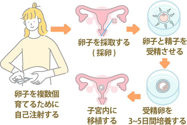 【図解でわかる】初めての体外受精(IVF)|対象の人や流れを詳しく解説 | にしたんARTクリニック