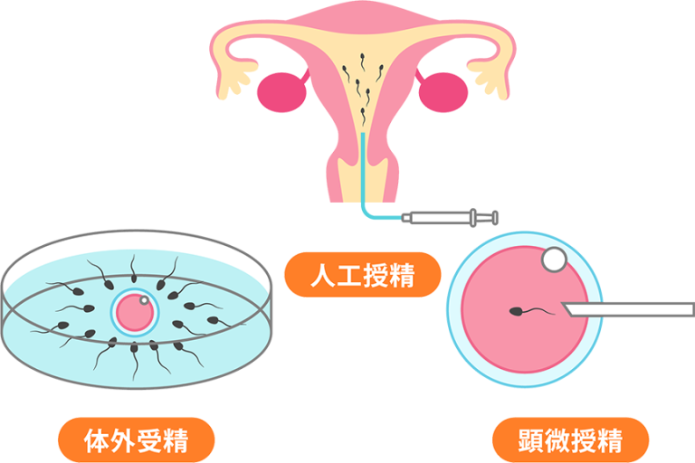 【図解でわかる】初めての体外受精(IVF)|対象の人や流れを詳しく解説 | にしたんARTクリニック