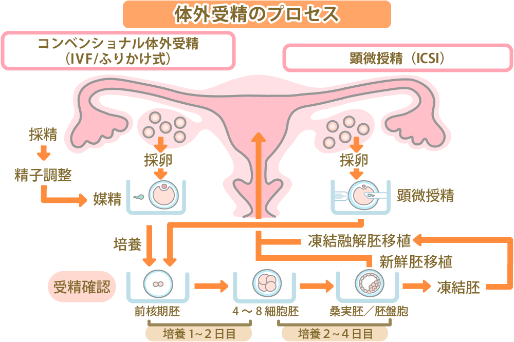 体外受精(IVF)時の採卵から移植までのスケジュールは？治療の流れを解説