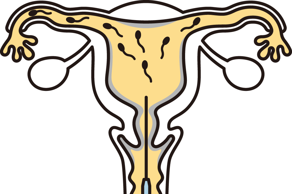 人工授精(AIH)にかかる費用はどのくらい？保険適用について解説