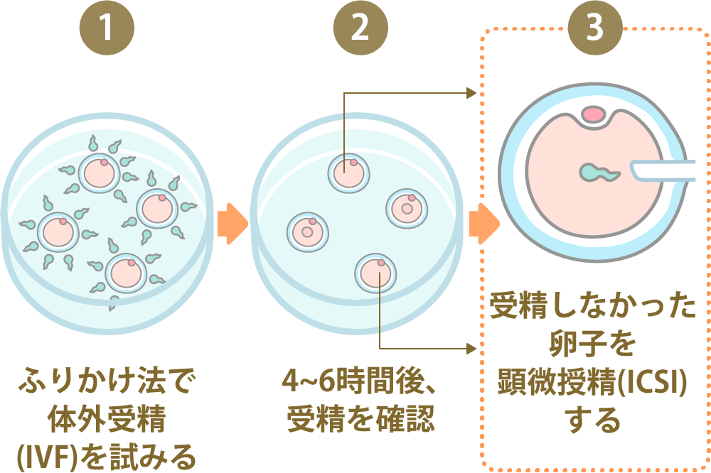 体外受精(IVF)と顕微授精(ICSI) と生殖補助医療(ART)の種類について解説 | にしたんARTクリニック