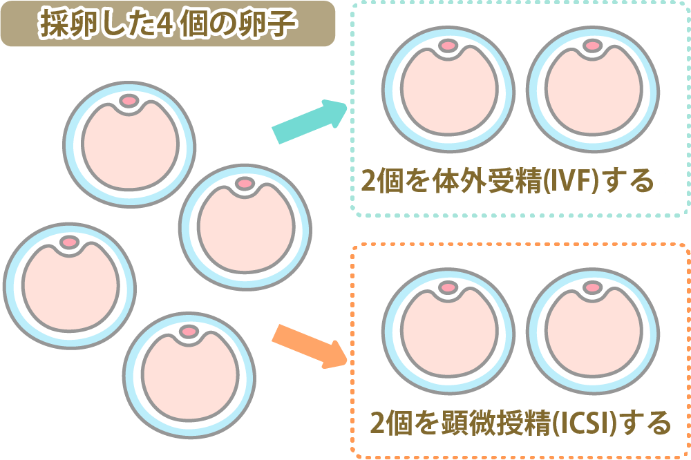 体外受精(IVF)と顕微授精(ICSI) と生殖補助医療(ART)の種類について解説 | にしたんARTクリニック