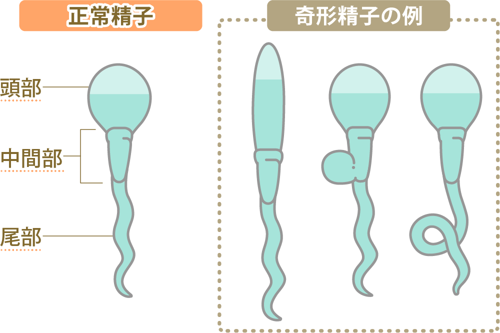 正常な精子と異常な精子の例