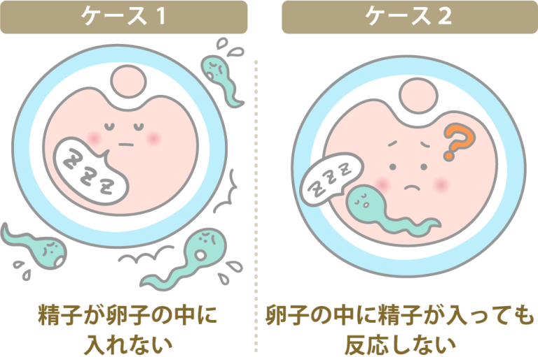 体外受精(IVF)と顕微授精(ICSI) と生殖補助医療(ART)の種類について解説 | にしたんARTクリニック